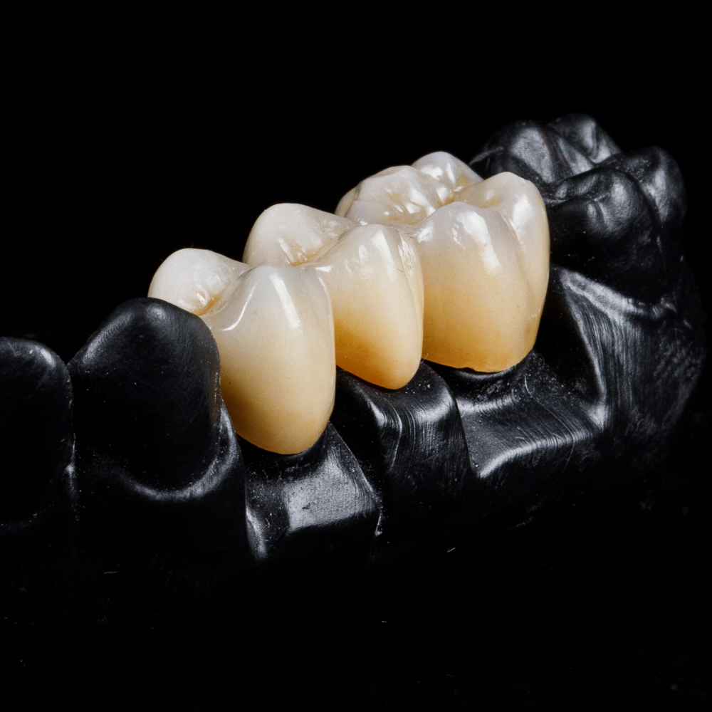 Chesapeake-Crown-and-Bridge_services_zirconia-crowns